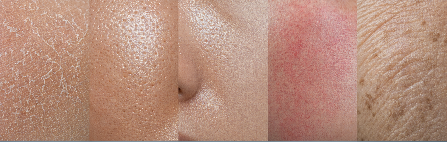Les 5 types de peau : sèche, grasse, mixte, sensible, mature